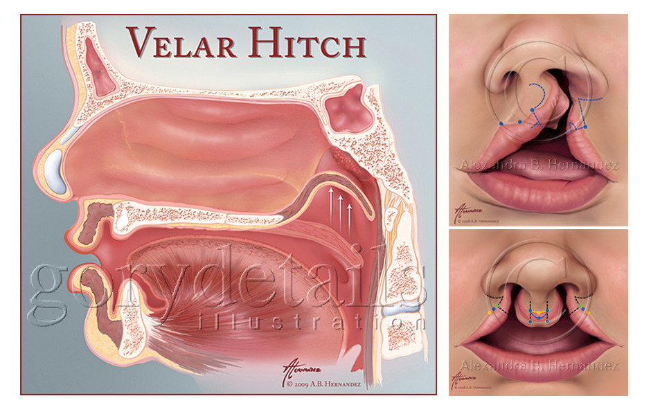 Velar Hitch for Cleft Palate Repair