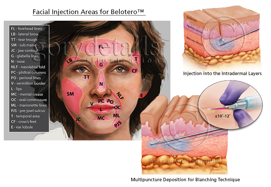 Illustration of injection areas for the injectable, Belotero™, as well as the correct injection zone and technique.