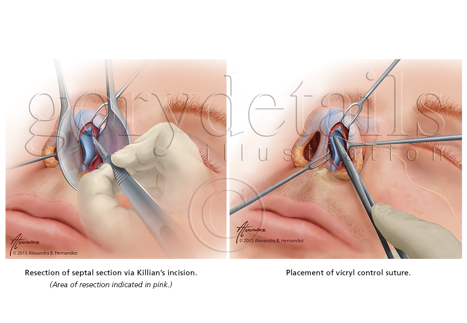 Figure showing resection of septal section and placement of a vicryl control suture for a septoplasty procedure.