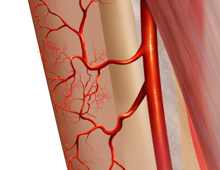 Peroneal Artery Perforator Flap